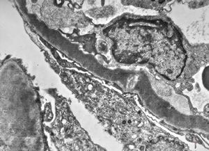 M,29y. | type II membranoproliferative glomerulonephritis (dense deposit disease)